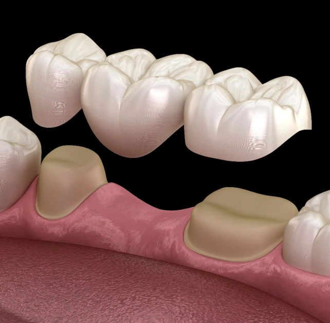 Custom dental crown restoration