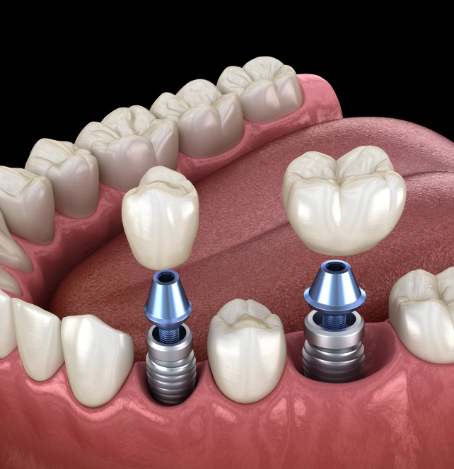 Dental implants in Euless